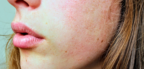 Trockene Haut – Was hilft dagegen?