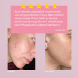 Hautproblem Unreine & Pickelige Haut
