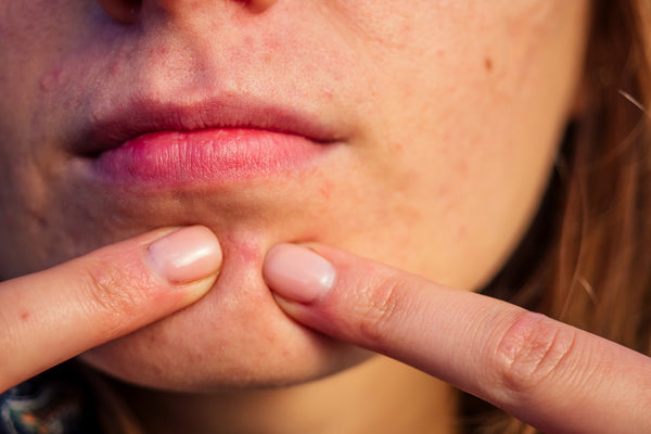 Erstverschlimmerung oder Skin Purging: Warum verschlechtert sich das Hautbild?